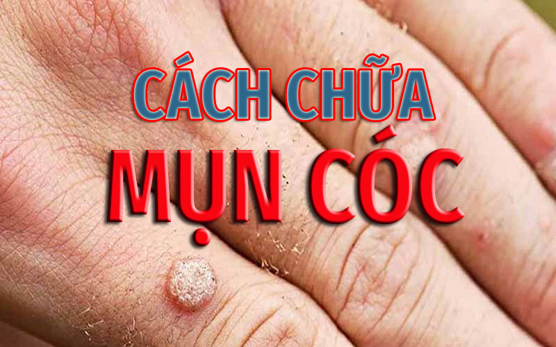 CACH CHUA MUN COC